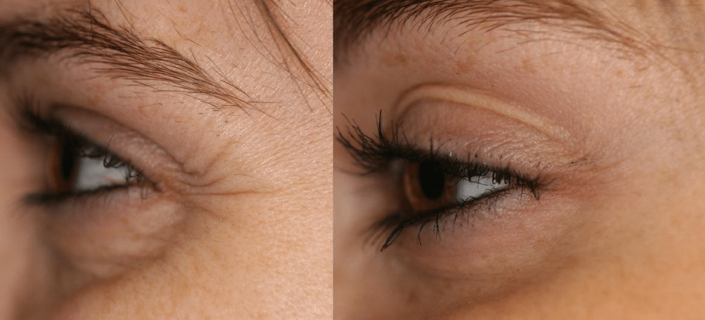 before and after images of crow's feet wrinkles removed