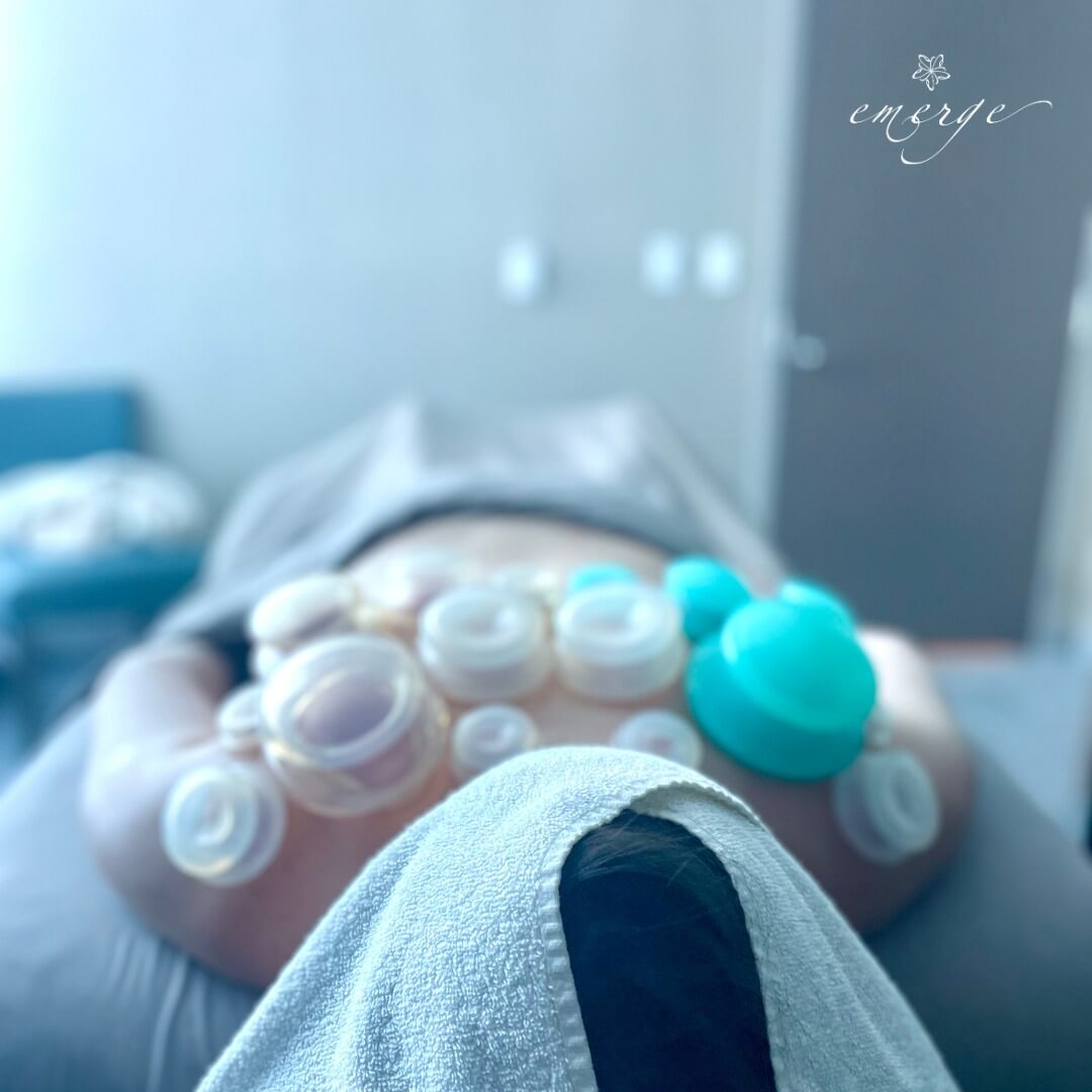 Cupping Therapy at Emerge